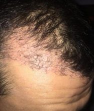 hair-transplant-turkey-reddit (4)