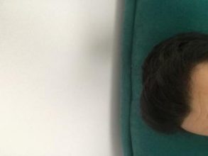 hair-transplant-turkey-reddit (5)