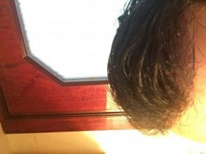 hair-transplant-turkey-results (1)