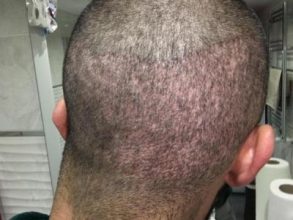 hair-transplant-turkey-results (2)