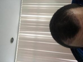 hair-transplant-turkey-results (4)