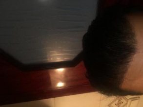 hair-transplant-turkey-results (5)