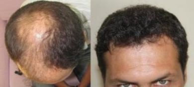 hair-transplant-turkey-review (1)