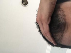 hair-transplant-turkey-review (1)
