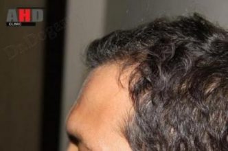 hair-transplant-turkey-review (10)
