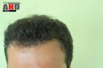 hair-transplant-turkey-review (11)