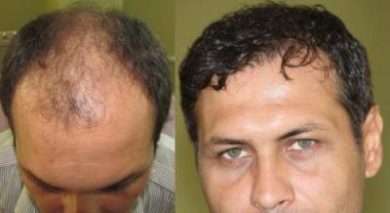 hair-transplant-turkey-review (12)