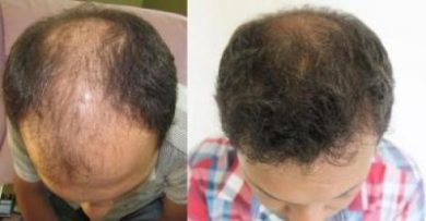 hair-transplant-turkey-review (13)