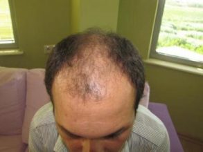 hair-transplant-turkey-review (2)