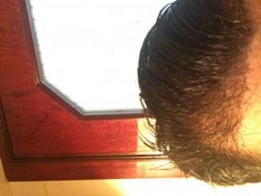 hair-transplant-turkey-review (2)