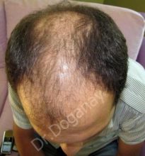 hair-transplant-turkey-review (3)