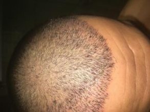 hair-transplant-turkey-review (3)