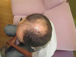 hair-transplant-turkey-review (4)