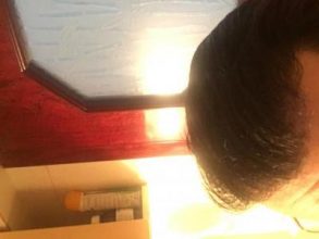 hair-transplant-turkey-review (4)