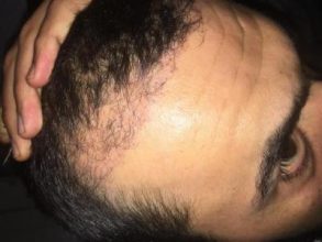 hair-transplant-turkey-review (5)