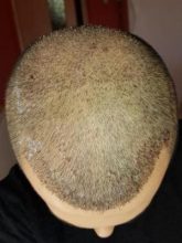 hair-transplant-turkey-surgery (10)