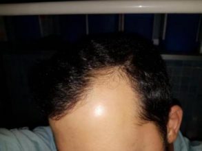 hair-transplant-turkey-surgery (11)