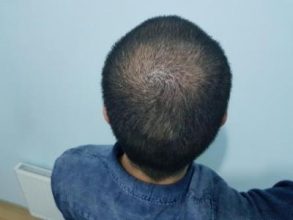 hair-transplant-turkey-surgery (12)