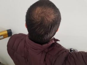 hair-transplant-turkey-surgery (13)