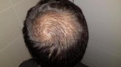 hair-transplant-turkey-surgery (14)