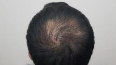 hair-transplant-turkey-surgery (15)