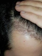 hair-transplant-turkey-surgery (16)