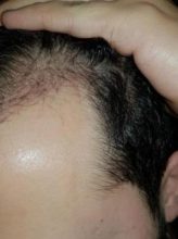 hair-transplant-turkey-surgery (17)