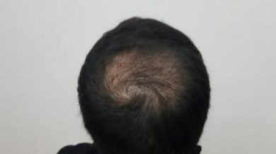 hair-transplant-turkey-surgery (18)