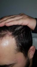 hair-transplant-turkey-surgery (19)