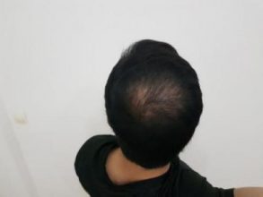 hair-transplant-turkey-surgery (2)