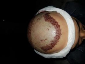 hair-transplant-turkey-surgery