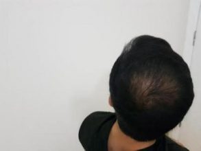 hair-transplant-turkey-surgery (3)