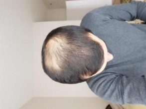 hair-transplant-turkey-surgery (4)
