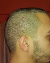 hair-transplant-turkey-surgery (6)
