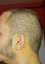 hair-transplant-turkey-surgery (7)