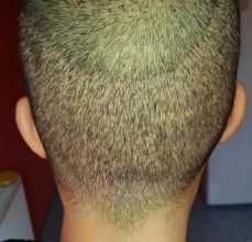hair-transplant-turkey-surgery (8)
