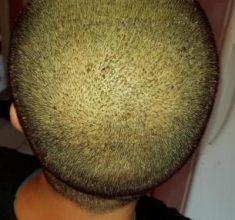 hair-transplant-turkey-surgery (9)