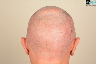 the-best-hair-transplant-in-turkey (1)