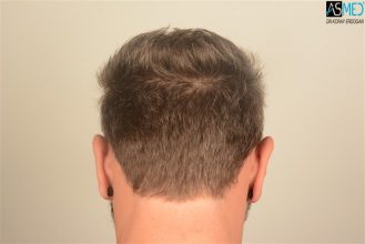 the-best-hair-transplant-in-turkey (10)