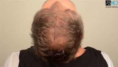 the-best-hair-transplant-in-turkey (11)