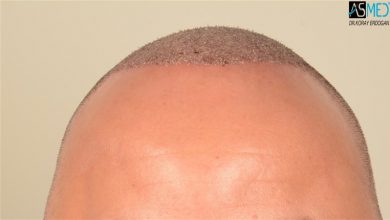 the-best-hair-transplant-in-turkey (12)