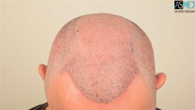 the-best-hair-transplant-in-turkey (13)