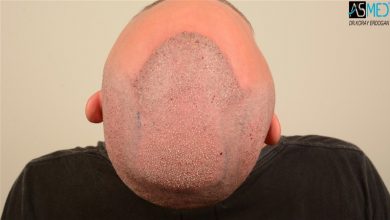 the-best-hair-transplant-in-turkey (2)