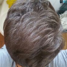 the-best-hair-transplant-in-turkey (4)