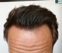 the-best-hair-transplant-in-turkey (5)