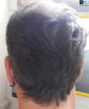 the-best-hair-transplant-in-turkey (6)