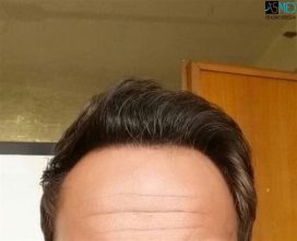 the-best-hair-transplant-in-turkey (7)
