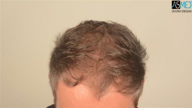 the-best-hair-transplant-in-turkey (9)
