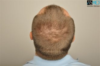 the-best-hair-transplant-surgeon-turkey (10)