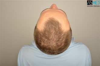 the-best-hair-transplant-surgeon-turkey (11)